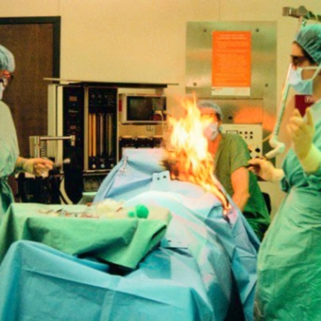 Woman’s fart sparks fire during surgery