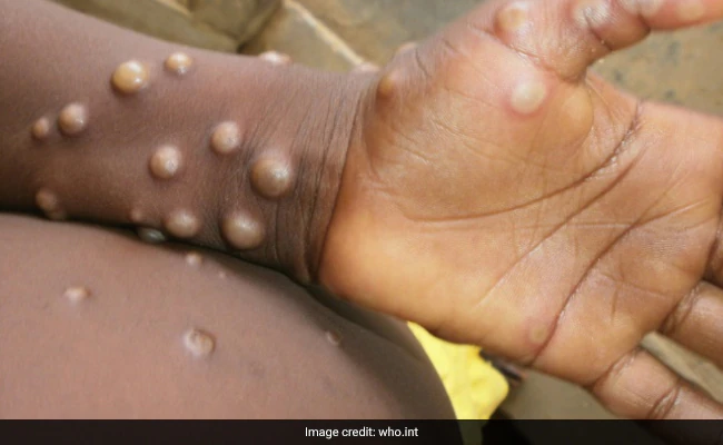 Ghana Health Service confirms monkeypox case in Western North Region