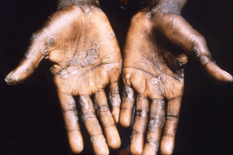 Monkeypox kills one in Upper East region