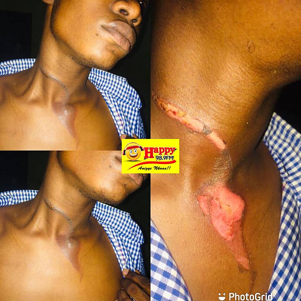 High School Brutalities: Student of Adaklu SHS burnt with hot pressing iron by colleague