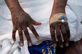 Zambia reports first Mpox Case, variant unclear